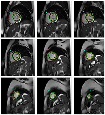 Left Ventricular Remodeling Following Balloon Mitral Valvuloplasty in Rheumatic Mitral Stenosis: Magnetic Resonance Imaging Study